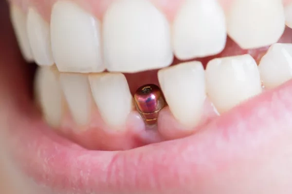 Durata de viaţă pentru un implant dentar