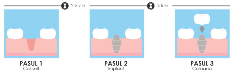 Etapele implantului dentar